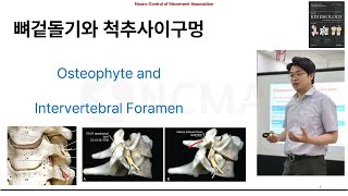 뉴만 기능해부학척추편 기초 뼈겉돌기와 척추사이구멍 osteophyte and intervertebral foramen [upl. by Eitteb]