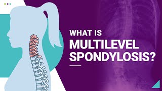 What is Multilevel Spondylosis [upl. by Getter]