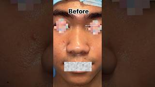 Asian Rhinoplasty by Dr Anil Kumar Kaler Nose job delhi nosejobs asian Contact8448150908 [upl. by Aerdnad]