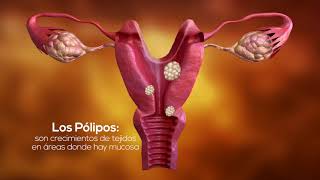 Pólipos Endometriales [upl. by Annaerdna]