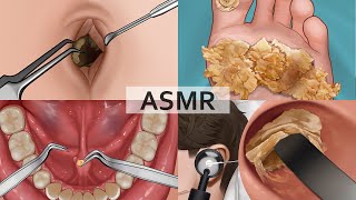 ASMR Collection 2 Remove Large Plantar Warts Huge Navel Stone Salivary Gland Stones Ear Cleaning [upl. by Ahsita]