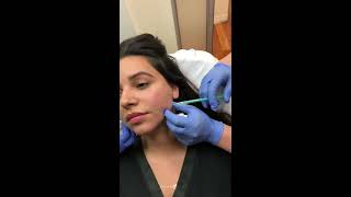 Live  Female Facial Sculpting  Cheek Chin and Jawline Augmentation with Restylane  Dr Jason Emer [upl. by Gerty564]