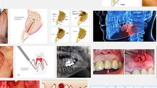 wieso die Wurzelspitzenresektion meistens nichts bringt [upl. by Etam376]