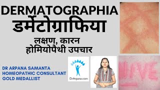 डर्मेटोग्राफिया हाइव्स लक्षण उपचार और कारण  DERMATOGRAPHIA Urticaria amp Homeopathic Treatment [upl. by Denna]