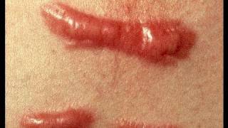 DermTV  How to Treat a Keloid Scar DermTVcom Epi 279 [upl. by Pickett]