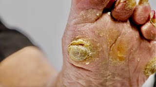 BEST CALLUS SCRAPING OF 2022 SUPER SATISFYING PART 2 [upl. by Viveca]