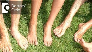 How to reduce itchy feet in teenage boys  Dr Rashmi Ravindra [upl. by Dazraf]