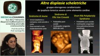 Ecografia del 2° trimestre diagnosi delle malformazioni screening anomalie cromosomiche [upl. by Treborsemaj]