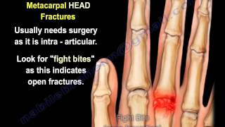 Metacarpal Fractures  Everything You Need To Know  Dr Nabil Ebraheim [upl. by Yllitnahc]