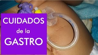 Gastrostomía  Lavado de sonda y como evitar taponamientos [upl. by Earl]