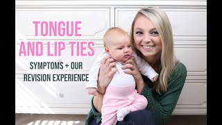 TONGUE AND LIP TIE SYMPTOMS IN BABIES  TONGUE AND LIP TIE LASER REVISION EXPERIENCE [upl. by Saduj]