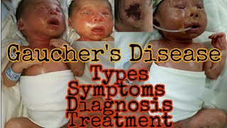 Gaucher Disease  Types symptoms diagnosis treatment  MisMedicine [upl. by Oeht364]