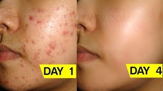 Face Wash for Pimples  Ways to Stop or Cure Pimples Beauty Tips in Tamil [upl. by Beniamino]