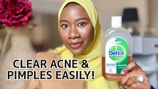 How to use DETTOL Antiseptic Liquid to clear acne How to get rid of pimples with Dettol [upl. by Ohare]