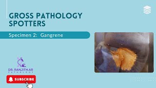 Gross Pathology spotters  Gangrene [upl. by Aydin]