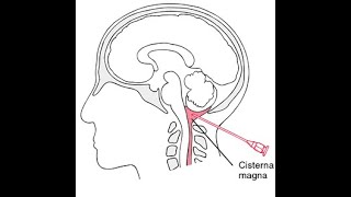 Mnemonics to remember structures pierced during Cisterna Puncture or Cisternal puncture [upl. by Annaerda]