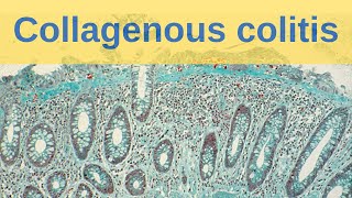 Collagenous Colitis  Pathology mini tutorial [upl. by Smaoht]