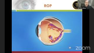 Retinopatía del prematuro tamizaje y abordaje Dr Pedro Escalera Arroyo [upl. by Hiltan]