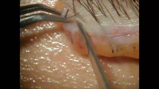 CLOSE UP of Slivering Hair Transplantation at the Farjo Hair Institute [upl. by Keven]