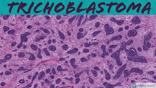 Trichoblastoma 5Minute Pathology Pearls [upl. by Boleslaw]