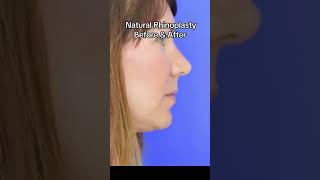 Rhinoplasty before amp after [upl. by Gridley]