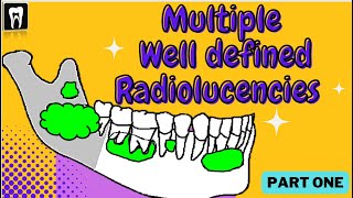 Multiple Separate Radiolucency With Well Defined Borders  Oral Radiology  Oral Pathology  OKC [upl. by Kosak]