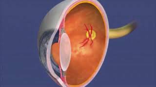 Laser Treatment of Retinopathy of prematurity ROP [upl. by Rj]