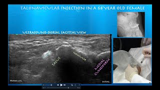 Ultrasound Guided Talonavicular Joint Cortisone Injection in a 68 Year Old Female [upl. by Cirdla]