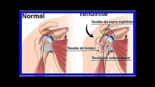 Behandlung von Tendinitis in der Schulter [upl. by Ennayk]