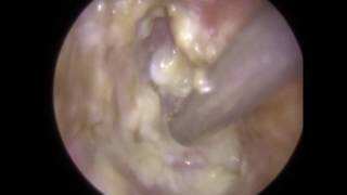 Glue Ear amp ETD in Revealed After Ear Wax Removal  Mr Neel Raithatha THC [upl. by Harriett]