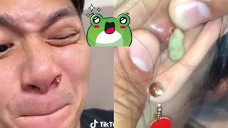 The Ultimate Acne Removal Satisfying Compilation Best Blackheads amp Pimple Popping Videos [upl. by Merrill]