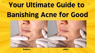 Clear Skin Secrets The Ultimate Guide to Banishing Acne for Good [upl. by Ulrich131]