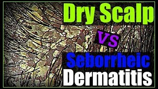 How to Get Rid of Dandruff Seborrheic Dermatitis amp Dry Scalp [upl. by Ahseila]