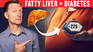 Revealing the Shocking Connection Fatty Liver and Diabetes [upl. by Lindi987]