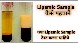 Lipemic blood sample  Lipemic  Lipemic serum [upl. by Canfield505]