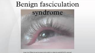 Benign fasciculation syndrome [upl. by Gardia183]