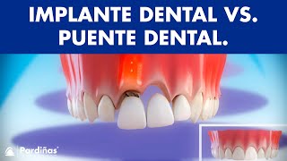 Implante dental VS Puente dental fijo sobre diente natural  ¿Cuál es mejor © [upl. by Ahsilak]