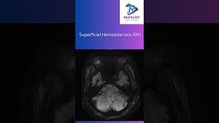 Superficial HemosiderosisSuperficialHemosiderosisNeuroRadiologyMRIImaging SusceptibilityMRI [upl. by Jangro839]