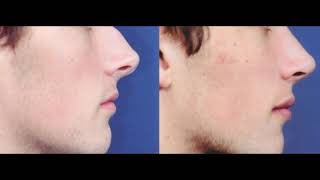 How to get perfect nose at home in a week MORE POWERFUL [upl. by Assek]