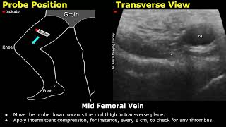 Femoral Vein Doppler Ultrasound Probe Positioning  Lower Limb Veins USG Scanning Technique [upl. by Eneladgam]