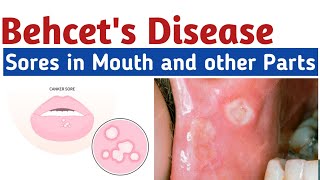 Behcets Disease  Symptoms Causes And Mouth sores treatment  how to get rid of mouth blisters [upl. by Yerffeg]