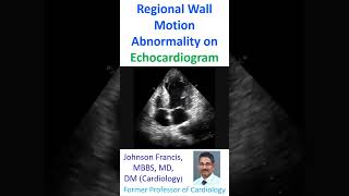 Regional Wall Motion Abnormality on Echocardiogram [upl. by Celine]