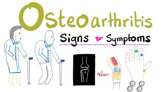 Osteoarthritis OA  Signs and Symptoms  Clincal Manifestations  Rheumatology Series [upl. by Soutor]