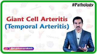 Giant cell arteritis Temporal arteritis Vasculitis Pathology  Usmle Step 1 [upl. by Bohun]