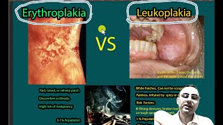 Erythroplakia Vs Leukoplakia Symptoms causes risk of malignancies [upl. by Mccutcheon728]