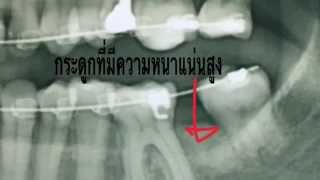 Ep32 หมุดจัดฟันดึงฟันคุด ตัวอย่าง1 [upl. by Aundrea]