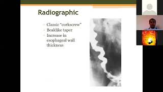 Why Cant I Swallow The Science Behind Dysphagia [upl. by Hamforrd]