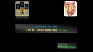 Ultrasound Case 13  Acute Sialadenitis Web case [upl. by Aneehsat]