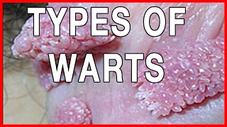 Types of Warts Genital Warts Information Symptoms and Pictures [upl. by Ennovyahs]