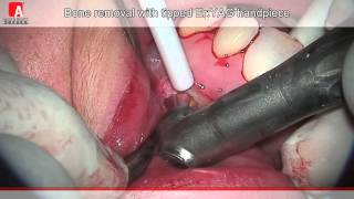 APICOECTOMY Fotona Lightwalker ErYAG laser [upl. by Arremat740]